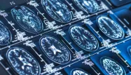 La maladie d'Alzheimer est la forme la plus courante de démence.